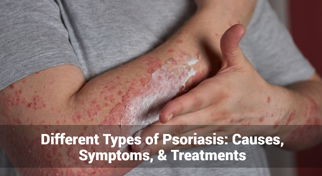 Different Types of Psoriasis: Causes, Symptoms, & Treatments